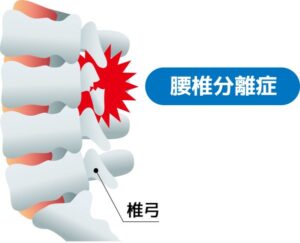 腰椎分離症のイラスト