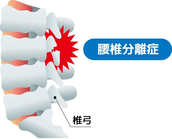 腰椎分離症のイラスト