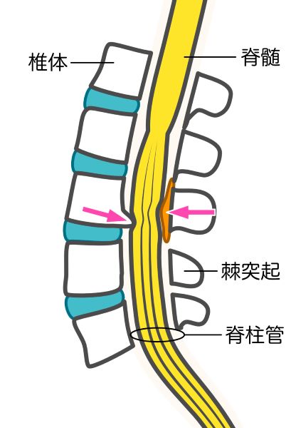 脊柱管狭窄症のイラスト