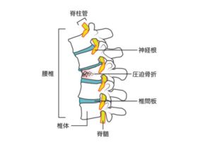 腰椎圧迫骨折のイラスト