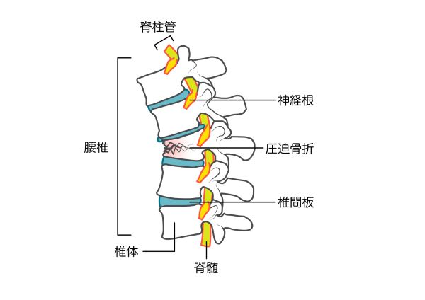 腰椎圧迫骨折のイラスト