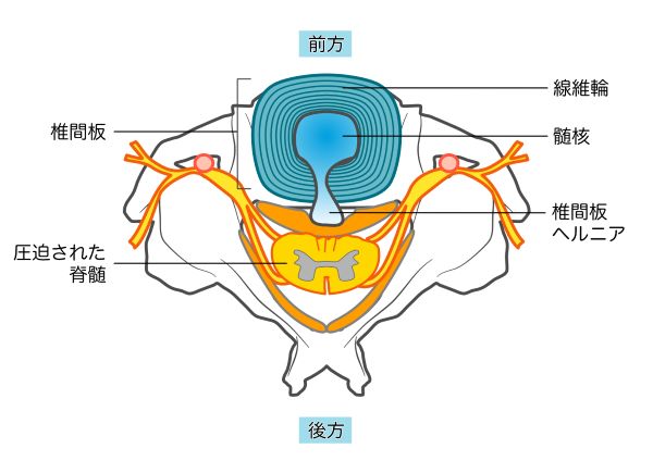 椎間板ヘルニアのイラスト