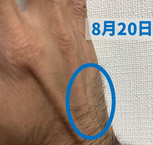 第5中手骨(8月20日の様子)正面斜めから