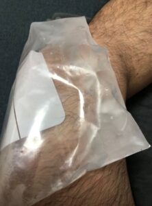 氷水の入ったフリーザーバッグを膝に当てる