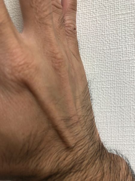 第5中手骨骨折を手の甲斜めから見た様子（2026年8月11日）