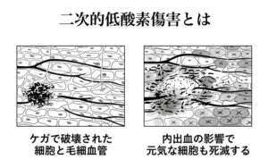二次的低酸素傷害のメカニズム