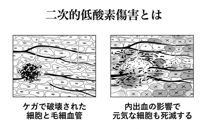 二次的低酸素傷害のメカニズム