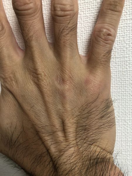 第5中手骨骨折を手の甲から見た様子（2026年8月11日）