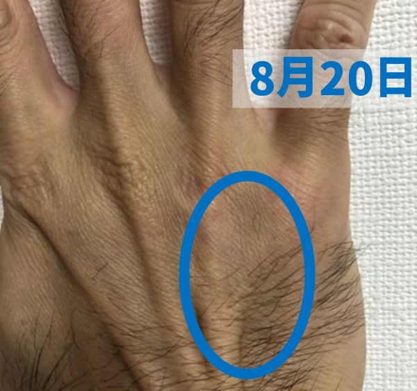 第5中手骨(8月20日の様子)正面から